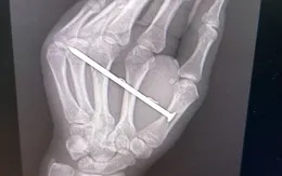 Cảnh báo tai nạn lao động nguy hiểm từ máy bắn đinh