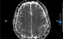 Đau đầu dữ dội, co giật sau 10 năm dùng thuốc tránh thai: Cảnh báo đột quỵ hiếm gặp