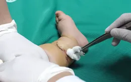Phẫu thuật thành công ca "ngấn ối" hiếm gặp ở trẻ 10 tháng tuổi