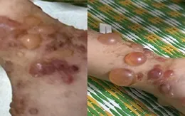 Bệnh IgA bọng nước thành dải - bệnh da tự miễn hiếm gặp