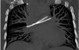 Dị vật "trôi" vào tim từ catheter để lâu năm