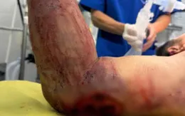 Tai nạn nổ bình gas, cảnh báo an toàn lao động tại nhà