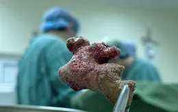 Đừng chủ quan với sỏi niệu quản