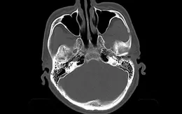 Ngã nhẹ ở người cao tuổi có thể gây chấn thương sọ não tử vong