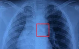 Gắp răng trong đường thở, cứu bé trai 10 tuổi sau tai nạn