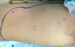 Những triệu chứng ban đầu dễ bị bỏ qua của bệnh do não mô cầu