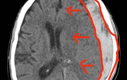 Cứu sống bệnh nhân tụ máu dưới màng cứng cấp tính