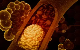 Rối loạn mỡ máu - nguy cơ âm thầm gây nhồi máu cơ tim ở người trẻ