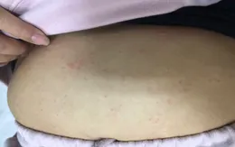 Nguy hiểm từ tự ý dùng thuốc, gia tăng ca sốc phản vệ