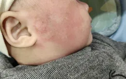 Đưa trẻ đi khám sớm khi có dấu hiệu bất thường về da