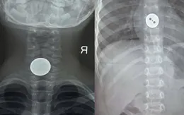Cảnh báo tình trạng trẻ nuốt dị vật