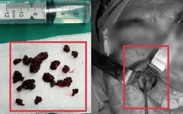 Đau xoang, cứng hàm tưởng uốn ván, bác sĩ phát hiện nấm đen xâm lấn