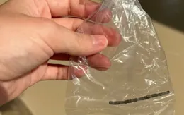 Bé 32 tháng tuổi thủng ruột do nuốt 24 viên nam châm