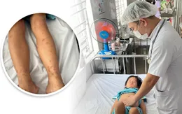 Infographic: Viêm mao mạch dị ứng ở trẻ em - Những điều cha mẹ cần biết