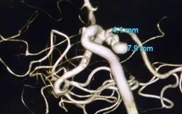 Đau đầu kéo dài, vào viện phát hiện khối phình mạch não kích thước lớn