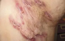 Viêm tuyến mồ hôi mủ không phải mụn nhọt thông thường