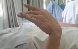 Liệt thần kinh quay do tư thế ngủ sai: Cảnh báo từ thói quen tưởng chừng vô hại