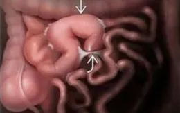 Tắc ruột do dây chằng - biến chứng nguy hiểm sau phẫu thuật ổ bụng không thể chủ quan