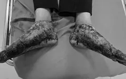 Ngâm chân nước lá đun nóng, người phụ nữ bỏng nặng hai bàn chân