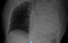 Xẹp toàn bộ phổi trái do dị vật đường thở