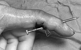 Tai nạn lao động nguy hiểm: Đinh dài 5cm xuyên ngón tay người phụ nữ