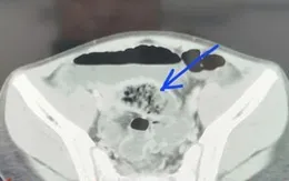 Hoại tử ruột do túi thừa Meckel