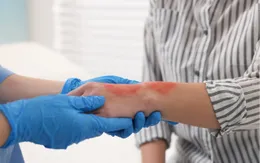 Bỏng - tai nạn thường gặp trong những ngày rét sâu