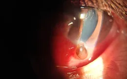 Chủ quan sau chấn thương, người bệnh đối mặt nguy cơ mất thị lực