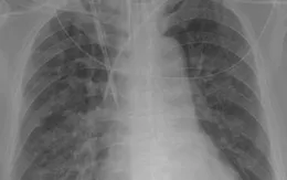 Điều trị thành công ca viêm phổi nặng nghi do tụ cầu ở trẻ 14 tháng tuổi