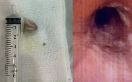 Kịp thời gắp xương lợn mắc kẹt trong phế quản người bệnh