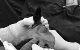 Giữ lại ngón tay trước nguy cơ cắt bỏ nhờ phẫu thuật tạo hình chuyên sâu