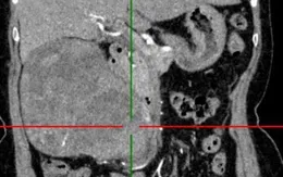 Đau âm ỉ lưng hông, vào viện phát hiện khối u thận lớn