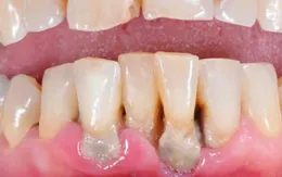 Bệnh nha chu - nguyên nhân hàng đầu gây mất răng ở người trưởng thành