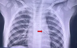 Cấp cứu bệnh nhi hóc kim cúc dài 3cm vào đường thở