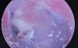 Chủ quan chưa mổ sớm cholesteatoma tai giữa, bệnh nhi 6 tuổi gặp biến chứng