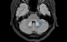 Thuốc lợi sữa không rõ nguồn gốc: Nguy cơ tổn thương não sau sinh