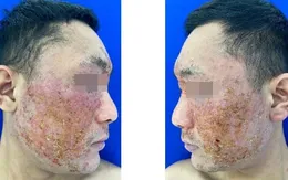 Viêm da tiếp xúc dị ứng vùng mặt: Đừng xem nhẹ kích ứng da