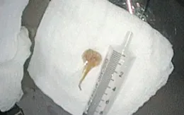 Gắp dị vật đường thở cứu bệnh nhân nguy kịch