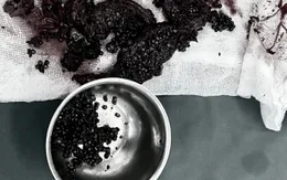 Nội soi lấy hơn 300 viên sỏi mật cho người bệnh