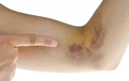 Ngày Thế giới Phòng, chống ung thư (4/2): Cảnh báo dấu hiệu ung thư ở trẻ em