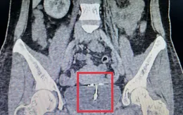 Cảnh báo biến chứng hiếm gặp: Vòng tránh thai xuyên tử cung vào bàng quang