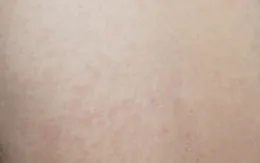 Mùa đông - xuân và bệnh sởi: Lưu ý nhóm trẻ dễ tiến triển nặng