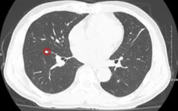 3 dấu hiệu cảnh báo nguy hiểm của ung thư phổi giai đoạn muộn