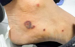 Biến chứng viêm mạch nguy hiểm xuất phát từ ban xuất huyết nhỏ ở chân