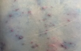Thủy đậu có thể biến chứng nguy kịch ở người có bệnh nền