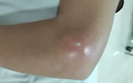 Cảnh báo biến chứng viêm khớp dạng thấp