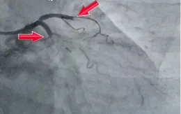 Phối hợp đa chuyên khoa cứu sống cụ bà 78 tuổi ngừng tim