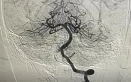 Bé trai 10 tuổi nhồi máu não khi đang chơi thể thao