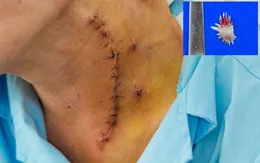 Cảnh báo nguy hiểm từ dị vật xương cá ở thực quản