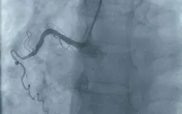 Cấp cứu kịp thời, cứu sống người bệnh nhồi máu cơ tim